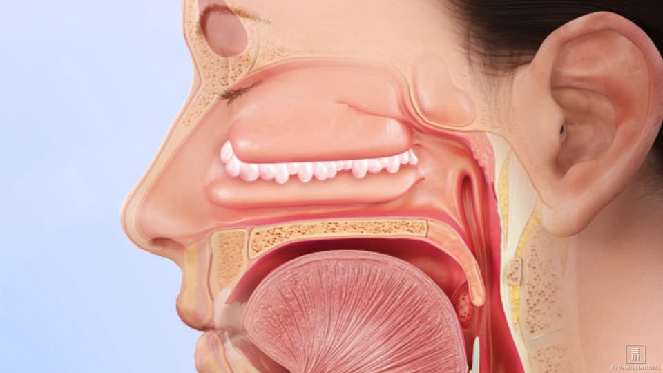 large nasal polyps